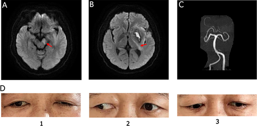 Figure 2 Postoperative magnetic resonance imaging (MRI) and magnetic resonance angiography (MRA) findings and manifestations of oculomotor nerve palsy. (A) MRI suggests infarction of the left cerebral peduncle (shown by arrow). (B) MRI indicates left basal ganglia infarction (shown by arrows). (C) No stenosis of the bilateral posterior cerebral arteries was found on cranial MRA. (D) At 18 days of onset, left blepharoptosis, adduction, and white of the left eye, and inadequate downward gaze of the left eye.