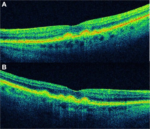 Figure 4 (A and B) Bilateral drusenoid pigment epithelial detachment is observed on Cirrus™ optical coherence tomography.