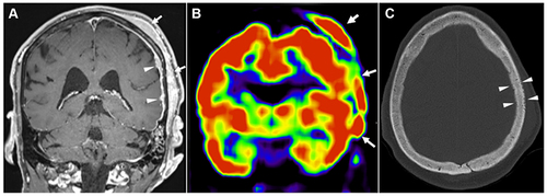 Figure 1 Initial FDG PET-MRI Images. (A) Coronal contrast enhanced T1 weighted MRI shows infiltrating subgaleal mass (arrows) with abnormal enhancement of the underlying calvarial marrow and nodular thickening of the dura (arrowheads). (B) The infiltrating mass is hypermetabolic on FDG-PET (arrows). (C) High-resolution CT of the skull reveals permeative erosions and slightly increased density of the involved parietal bone.