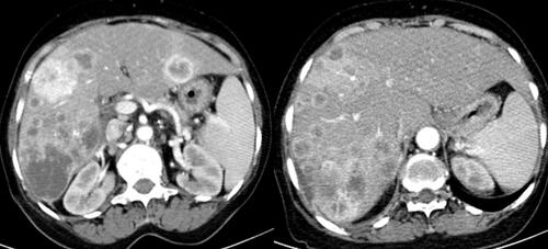 Figure 1 Contrast abdominal Computed tomography shows multifocal heterogeneous contrast-enhancing lesion in both liver lobes.