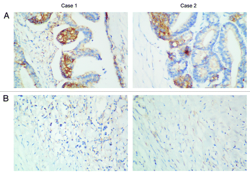 Figure 3. PDGFRα staining in two cases. (A) PDGFRα staining showed positive staining at the plasmalemma of the glandular cells. (B) Adjacent lung tissues of tumors in two cases showed negative expression of PDGFRα. Representative photomicrographs are shown at the original magnification × 400.
