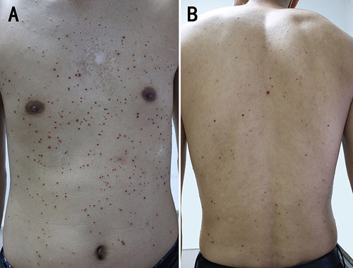 Figure 1 (A and B) Physical examination revealed approximately 400 dome-shaped, smooth-surfaced, and ruby-colored papules on his chest, abdomen, back, and proximal extremities. The diameters of these papules ranged from 1 to 5 mm.