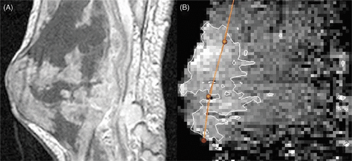 Figure 2. HT treatment in a patient with sarcoma. Morphologic image (A) and temperature map with superimposed 42°C isotherms. Also shown is the catheter for insertion of a temperature sensor (B).