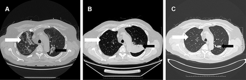 Figure 1 A chest CT scan of the 66-year-old man showing Pneumocystis jirovecii Pneumonia and Mycobacterium tuberculosis Infection. (A) A transverse chest CT scan obtained on the first day after admission showed multiple ground-glass opacities in both lungs (white arrow), and an area of consolidation in the left upper lung lobe (black arrow). (B) A follow-up chest CT scan obtained 1 month after admission showed the ground-glass opacities in both lungs were reduced (white arrow), but the left upper lobe consolidation was enlarged (black arrow). (C) A follow-up chest CT scan obtained on month 41 after initial admission showed gradual absorption of the ground glass opacities in both lungs (white arrow), a decrease in the left upper lobe consolidation, and a gradual disappearance of the multiple lung nodules (black arrow).