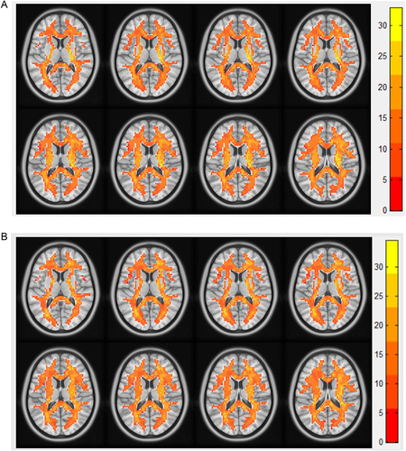 Figure 2 Results of the two components representing the white matter ALFF signal values by one-sample t-test in patients with (A) PACG and (B) HC.