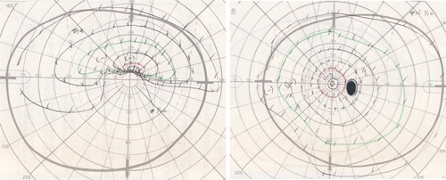 Figure 3 Goldmann perimetry at onset.