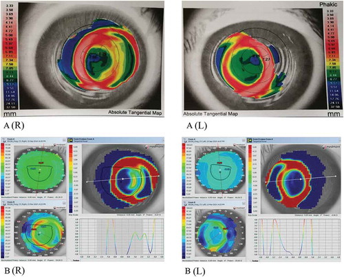 Figure 1. Corneal topography indicating lens decentration. A: 15-month visit, B: 18-month visit. R-right eye, L-left eye. The Aladdin HW3.0 (Topcon Medical Systems. Inc., Oakland US) was used at 15-month visit, and the Medmont E300 (Version 6.1.2, Medmont Pty. Ltd., Camberwell Australia) was used at 18-month visit