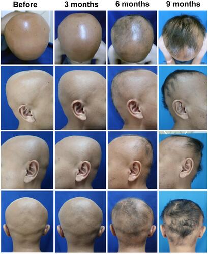 Figure 1 Comparison of alopecia universalis in a 19-year-old male patient before and after 3, 6, and 9 months systemic therapy of methotrexate (15 mg per week orally) and corticosteroids (16 mg per day orally) with topical minoxidil 5% showed hair growth on the scalp. The SALT score was improved from 100% (before treatment) became 41% (9 months after treatment).