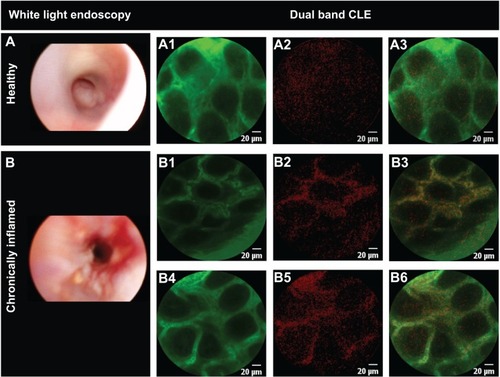 Figure 3 Differential nanoparticle distribution in inflamed and healthy mucosa.Notes: Selected images of healthy (A) (n=3) and chronically inflamed (B) (n=3) mouse mucosa, upon intravenous administration of ANANAS-red681 in phosphate-buffered saline containing 1% fluorescein. CLE images were acquired in the green (A1, B1, B4) and red (A2, B2, B5) channels. Merged red and green images are shown in panels A3, B3, and B6. The yellow color corresponds to the merged signal from green and red channels.Abbreviations: ANANAS, avidin-nucleic acid nanoassembly; CLE, confocal laser endomicroscopy.