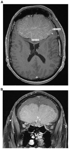 Figure 2 Contrast-enhanced T1 axial (A) and noncontrast T1 fat-suppressed coronal (B) magnetic resonance image revealing a large avidly enhancing midline extra-axial mass within the frontal region compressing the region of the optic chiasm and bilateral intracranial optic nerves.