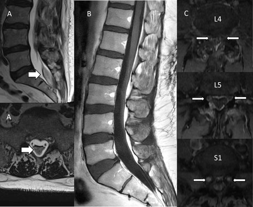 Figure 1 Arachnoiditis post pain interventional procedures (A) Case 1; (B) Case 2; (C) Case 3. Arrows indicate arachnoiditis.