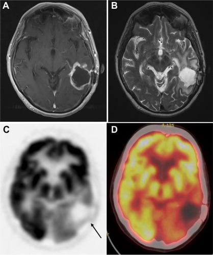 Figure 5 18F-FDG PET for tumor recurrence: 71-year-old male patient with history of glioblastoma multiforme, status post-resection presents for evaluation of recurrence.Notes: Contrast-enhanced MR T1 images (A) demonstrate a large cavity in the left posterotemporal-parietal junction with an irregular rim of enhancement. T2-weighted MR images (B) demonstrate hyperintensity in the posterotemporal and parietal lobes. These findings are suspicious for tumor recurrence around the periphery of previous location of mass in the left posterior temporoparietal region. (C) 18F-FDG PET only and (D) PET-CT fusion images demonstrate a relatively large area of absent 18F-FDG uptake corresponding to the cavity noted on MRI, with no area of abnormally increased 18F-FDG to suggest the presence of residual or recurrent high-grade viable tumor.Abbreviations: CT, computed tomography; FDG, 2-fluorodeoxyglucose; MR, magnetic resonance; MRI, magnetic resonance imaging; PET, positron emission tomography.