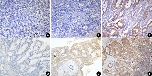 Figure 1 Expression of DCAMKL-1 protein in colorectal adenoma, CRC, paracancerous intestinal mucosa, and lymph node metastasis tissues (100× magnification). (A) negative DCAMKL-1 expression in paracancerous intestinal mucosal tissue; (B) negative DCAMKL-1 expression in CRC tissue; (C) positive DCAMKL-1 expression in CRC tissue; (D) negative DCAMKL-1 expression in colorectal adenoma; (E) positive DCAMKL-1 expression in colorectal adenoma; (F) positive DCAMKL-1 expression in lymph node metastases.