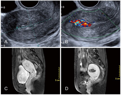 Figure 3. Image profile of a 32-year-old patient with UAVF. (A and B) Color Doppler ultrasonography of the patient’s uterus before HIFU treatment. (C) The pre-HIFU MR image showed a lesion located at the anterior wall of the uterus. (D) The post-HIFU MR showed non-perfusion in the lesion immediately after HIFU treatment.