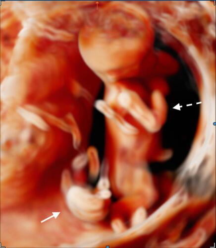 Figure 1 Panoramic three-dimensional view of a twin reversed arterial perfusion (TRAP) sequence at 15 weeks of gestation using Crystal Vue™ technique (Samsung Healthcare, Italy). Arrow: acardiac twin. Dashed arrow: pump twin.