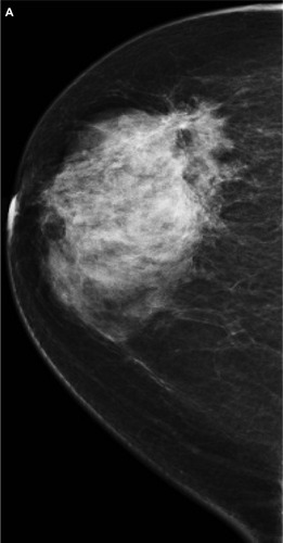 Figure 1 A 51-year-old female presented with hard right breast after suffering from right breast trauma 2 months previously. (A and B) Craniocaudal and mediolateral mammogram of the right breast revealed a dense breast with architectural distortion noted at upper outer quadrant (more evident on craniocaudal view). (C) Ultrasound revealed an ill-defined irregular hypoechoic mass with posterior acoustic shadowing at 9 o’clock of the right breast.