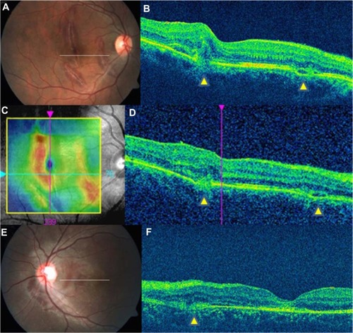 Figure 2 Type 2 indirect choroidal rupture (ICR). (A) Multiple macular ICRs. (B) Loss of continuity of the retinal pigment epithelium (RPE)-choriocapillaris (CC) and inner segment/outer segment layers with subretinal heme. Note the two sites of ruptures (yellow arrowheads). (C) RPE-ILM thickness map, which clearly delineates the rupture site. (D) Horizontal line scan further inferiorly in the same eye, showing no change in the nature of the ICRs (yellow arrowheads). (E) Peripapillary macular ICR. (F) Horizontal line scan at the level indicated in E. The posterior sagging of the retinal layers with loss of the RPE-CC is seen nasal to the fovea (yellow arrowhead).