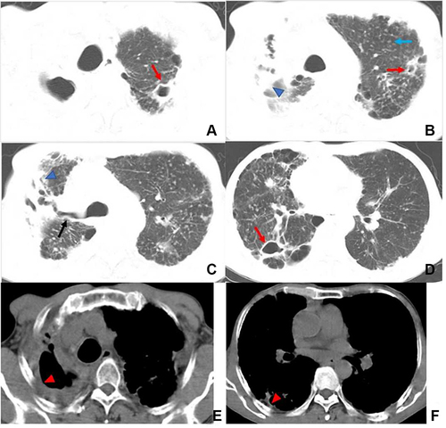 Figure 2 Multidrug-resistant pulmonary tuberculosis in a 48-year-old male patient. (A–D) Axial computed tomography images of the lung window indicate multiple cavities (red arrow), centrilobular micronodules and tree-in-bud sign (blue arrow), right main bronchus stenosis (black arrow), and right upper lobe destruction with bronchiectasis and distortion (blue arrowhead). (E and F) Axial computed tomography images of the mediastinal window indicate right pleural thickening (red arrowhead).