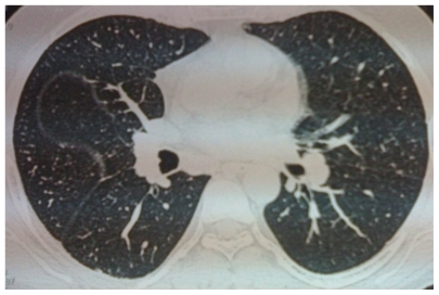 Figure 3 Computed tomography scan of the chest, revealing enlargement of paratracheal, subcarina, and hilar (bilateral) lymph nodes (after 1-year follow-up).