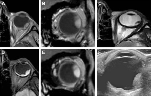 Figure 6 Imaging of choroidal melanoma on MRI and ultrasound scan.