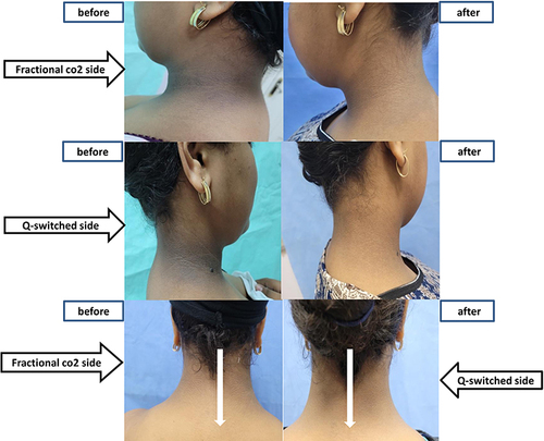Figure 7 Patient 4 clinical photos before and after treatment.