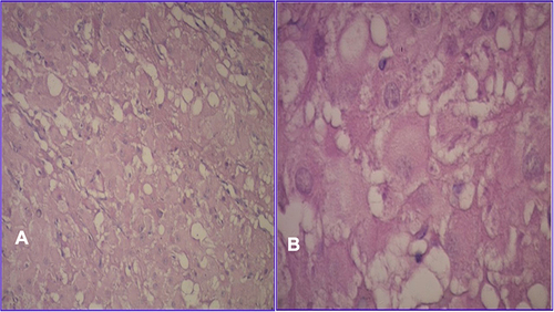 Figure 4 Granulosa lutein cells with abundant eosinophilic cytoplasm (A) and central vesicular nuclei (B). (H&E, AΧ10, BΧ40).