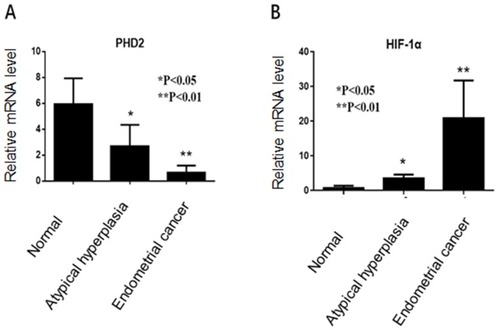 Figure 1 PHD2 and HIF-1α mRNA expression in normal endometrium, atypical endometrial hyperplasia, and endometrial cancer. (A) PHD2 expression was reduced in endometrial cancer compared with normal endometrium (p<0.05, chi-square test). (B) The expression of HIF-1α was elevated in endometrial carcinoma compared with normal endometrium (p<0.05, chi-square test).