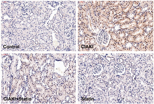 Figure 5. Atorvastatin dampened contrast-induced Caspase-3 expression in rat CIAKI model. Expression of Caspase-3 was demonstrated by immunohistochemical staining. In CIAKI group, expression of Caspase-3 was enhanced in renal tubular region. But in CIAKI + statin group, atorvastatin pretreatment dampened the contrast-induced Caspase-3 elevation.
