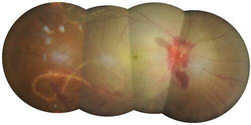 Figure 2 Large subretinal angiostrongyliasis with severe disk hemorrhage and extensive retinal whitening.