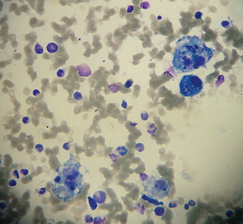 Figure 1. May–Grünwald–Giemsa stain of bone marrow aspirate smear showing four macrophages displaying massive hemophagocytic activity (magnification ×400).