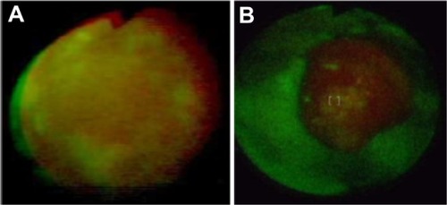 Figure 13 Monitoring of resistant to treatment acuminate condyloma in glans with autofluorescence method before (A) and during (B) treatment (until now no response).