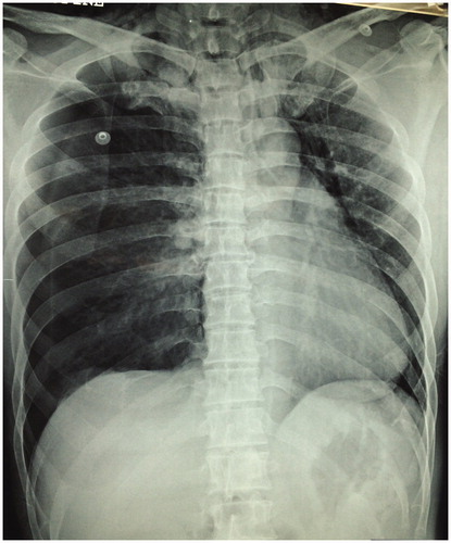 Figure 2. Chest radiograph showing bilateral pneumothorax with medialization of the heart to the left.