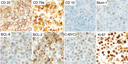 Figure 2 Immunohistochemical features of the patient’s tumor. The lymphoma cells were positive for CD20, CD79a, Mum-1 (dim), BCL-6, BCL-2, and C-MYC, and negative for CD10. Ki-67 proliferation index was about 90%. Original manifestation 400×.