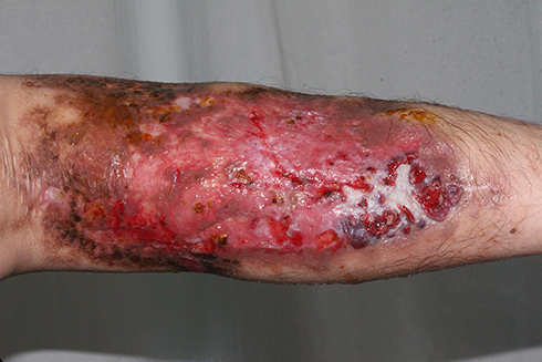 Figure 2 The lesion of the right lower leg after two debridements at admission. Multiple ulcers and a superficial scar were visible on the dorsal area of the right calf.