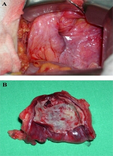 Figure 2 Intraoperative findings showed contricted hernia neck of the femoral hernia without herniation of abdominal viscera (A), and acute phlegmonous inflammation of the incarcerated hernia sac (B).