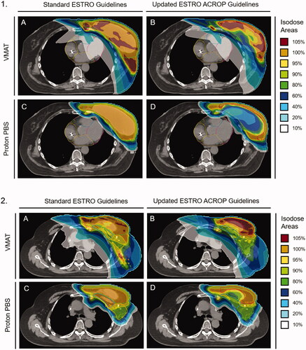 Figure 2. Representative isodose distribution from treatment plans using (A) VMAT with standard ESTRO guidelines, (B) VMAT with updated ACROP guidelines, (C) Proton PBS with standard ESTRO guidelines, and (D) Proton PBS updated ACROP guidelines. The 100% relative dose corresponds to an absolute dose of 50.4 Gy (RBE). All plans are for a single patient with pre-pectoral implant at the T8 level (Panel 1) and carina (Panel 2).