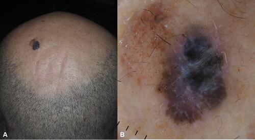 Figure 5 Nevus associated melanoma on the scalp of a 45-year old man. (A) An asymmetric lesion with brown and blue component. (B) In dermoscopy, on one side the congenital nevus with globular pattern is seen, on the other side the melanoma component with blue-white veil, shiny-white streaks.