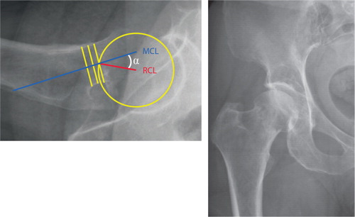 Figure 2. Garden I–II fracture of the right femoral neck. The posterior tilt angle (α) is defined by the mid-collum line (MCL) and the radius collum line (RCL) (Palm et al. Citation2009).