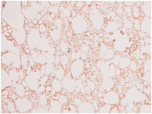 Figure 4. Immunohistochemistry for CD68, a histocyte marker, highlights numerous foam histocytes within the lesion on the external surface of the right capsule.