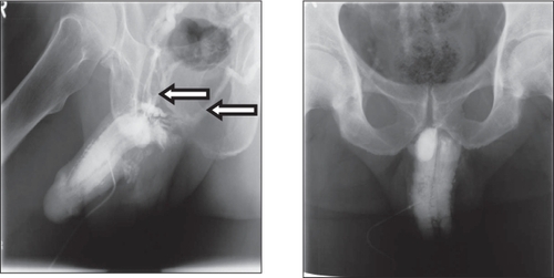 Figure 4 Disappearance of venous leakage evidenced by cavernosography in a hypogonadal man with erectile dysfunction at baseline (left) and after 3 months’ administration of testosterone undecanoate (right).