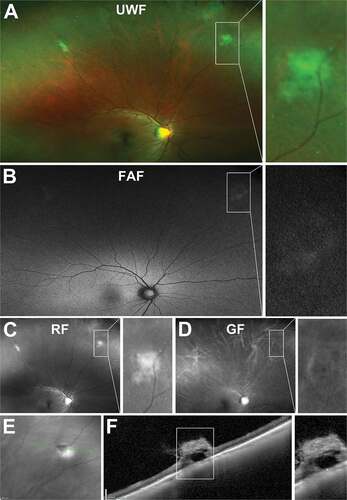 Figure 17. 43 year old Asian female with multiple cystic vitreoretinal tufts in the superior peripheral retina. (A) On UWF imaging, tufts appeared as bright, sharp lesions which remained visible on (B) red-free and (C) green-free images. (D) Infrared imaging shows lesions are hyporeflective and (E) peripheral OCT demonstrates tufts have a large, hyper-reflective apical tip extending into the vitreous with internal cystic spaces and loss of reflectivity of the underlying inner and outer retinal layers. Abbreviations as in Figure 3.