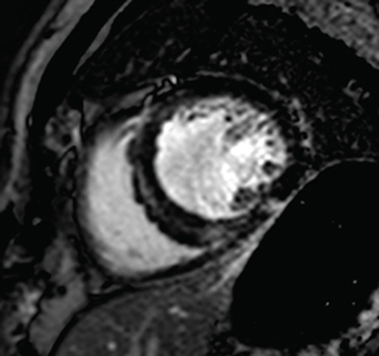 Figure 4. Delayed enhancement image demonstrating mid-wall fibrosis in a dilated cardiomyopathy.