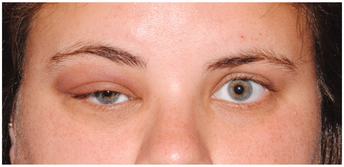 Figure 1.  External photograph on initial presentation showing right upper eyelid fullness, edema, and blepharoptosis.