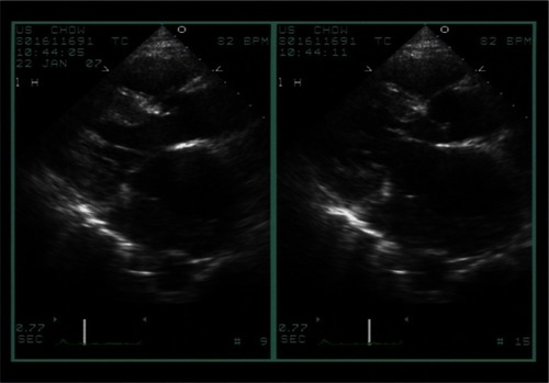 Figure 2 An ultrasonogram showing a massive infiltrative thickening of the posterior aspect of the left atrial septum and interatrial septum.
