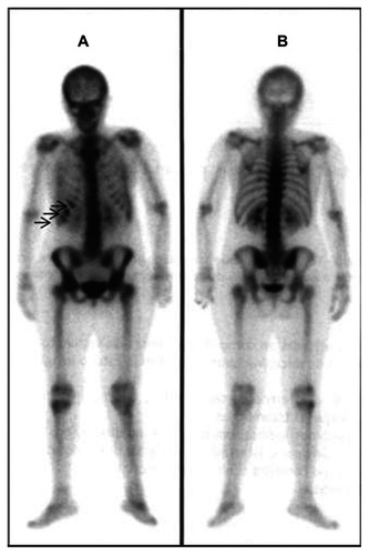 Figure 3 Bone scintigraphy (A, anterior view, B, posterior view) showing increased uptake in the 7th, 8th and 9th right ribs (arrows).