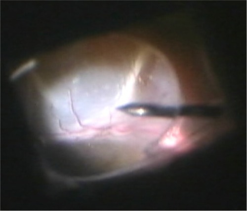 Figure 4 Intraoperative views during vitreous surgery.