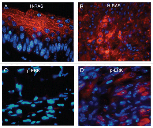 Figure 7 Expression of H-ras and phospho-Erk in sponataneous melanomas. (A and B) are representative immunofluorescent staining of H-ras in either normal ear pinna and spontaneous cutaneous melanomas derived from Tyr-HRas:Cdk4R24C/R24C mice respectively. Representative immunofluorescent staining with phospho-Erk in normal ear pinna (C). (D) shows immunofluorescent staining with phospho-Erk of spontaneous cutaneous melanoma derived from Tyr-HRas:Cdk4+/R24C mice. Magnification of (A, C and D) is 600x and (B) is 400x.