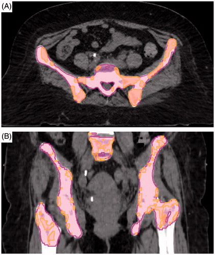 Figure 1. Representative volumes for pelvic bone marrow (pink) and active pelvic bone marrow (orange) contoured on axial (A) as well as coronal (B) CT slices.