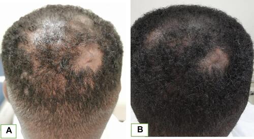 Figure 3 (A) Before treatment. (B) After 2 months of therapy showing partial hair regrowth.