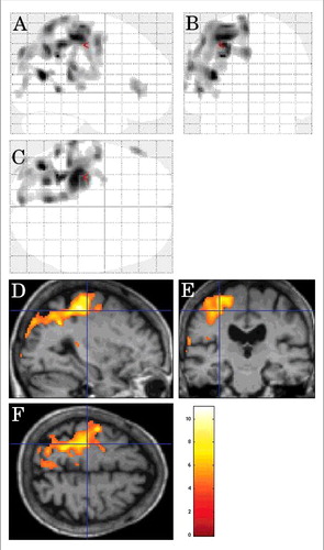 FIGURE 6. Inter-CJD SPM analysis showing hypometabolism in the left lateral prerolandic frontal cortex, the left -lateral more than mesial- parietal cortex, and the left lateral posterior temporal cortex in patients with corticobasal syndrome.